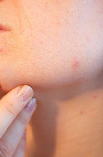 acne-1606765_1280